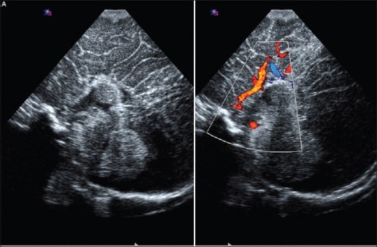 Imagem ultrassonogr&aacute;fica com Doppler colorido demonstrando fluxo vascular em regi&atilde;o abdominal, provavelmente visualizando a vasculariza&ccedil;&atilde;o do rim ou de um &oacute;rg&atilde;o adjacente. Os fluxos vermelho e azul indicam dire&ccedil;&atilde;o do sangue em rela&ccedil;&atilde;o ao transdutor, &uacute;til para avaliar perfus&atilde;o e poss&iacute;veis obstru&ccedil;&otilde;es vasculares.