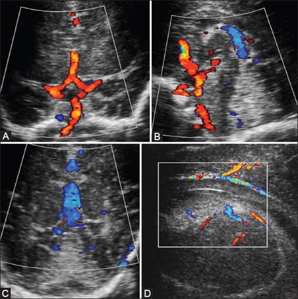 Doppler colorido em ultrassonografia cerebral neonatal mostrando vasculariza&ccedil;&atilde;o intracraniana com destaque para art&eacute;rias cerebrais m&eacute;dias e veias profundas