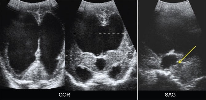 Ultrassonografia em planos coronal (COR) e sagital (SAG) mostrando uma estrutura c&iacute;stica de grande volume, provavelmente um cisto renal. Nota-se a presen&ccedil;a de m&uacute;ltiplos septos internos e uma parede espessa (seta amarela), sugerindo um cisto complexo que pode demandar avalia&ccedil;&atilde;o complementar para caracteriza&ccedil;&atilde;o.