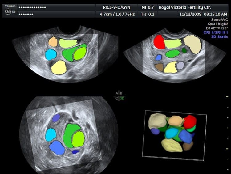 Ultrassonografia transvaginal 3D com segmenta&ccedil;&atilde;o colorida dos fol&iacute;culos ovarianos, demonstrando an&aacute;lise volum&eacute;trica de m&uacute;ltiplos fol&iacute;culos.