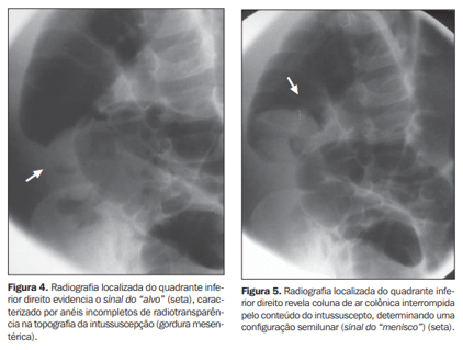 Radiografias abdominais evidenciando sinais radiol&oacute;gicos da intussuscep&ccedil;&atilde;o intestinal, com destaque para sinal do alvo e sinal do menisco no quadrante inferior direito.