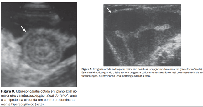 Imagens de ultrassonografia demonstrando sinais ecogr&aacute;ficos da intussuscep&ccedil;&atilde;o intestinal, incluindo sinal do alvo em corte axial e sinal do pseudo-rim em corte longitudinal.