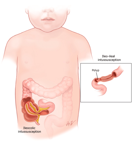 Ilustra&ccedil;&atilde;o m&eacute;dica de crian&ccedil;a com intussuscep&ccedil;&atilde;o intestinal, mostrando intussuscep&ccedil;&atilde;o ileoc&oacute;lica e &iacute;leo-ileal, com detalhe de p&oacute;lipo intestinal como ponto de invagina&ccedil;&atilde;o.