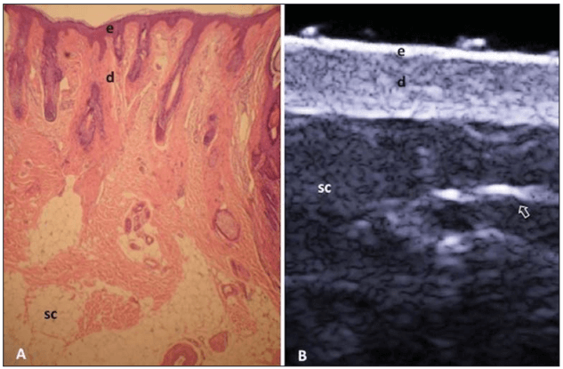 Corte histol&oacute;gico da pele humana ao lado de uma imagem de ultrassonografia de alta frequ&ecirc;ncia (USAF). A imagem histol&oacute;gica mostra as camadas da epiderme (e), derme (d) e tecido subcut&acirc;neo (sc). A imagem ultrassonogr&aacute;fica, em corte transversal, evidencia as mesmas camadas, com destaque para os septos fibrosos no subcut&acirc;neo.