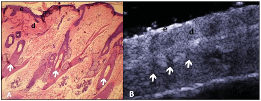 Compara&ccedil;&atilde;o entre histologia e ultrassonografia de alta frequ&ecirc;ncia (USAF) do couro cabeludo. &Agrave; esquerda, corte histol&oacute;gico mostrando a epiderme (e), derme (d) e fol&iacute;culos pilosos (indicados por setas). &Agrave; direita, imagem ultrassonogr&aacute;fica longitudinal evidenciando as mesmas estruturas: epiderme, derme e os fol&iacute;culos pilosos como &aacute;reas hipoecoicas alongadas.