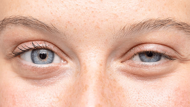 "Compara&ccedil;&atilde;o de p&aacute;lpebras com ptose unilateral, mostrando diferen&ccedil;a de eleva&ccedil;&atilde;o entre os olhos, uma caracter&iacute;stica comum em dist&uacute;rbios oculares como a ptose palpebral.