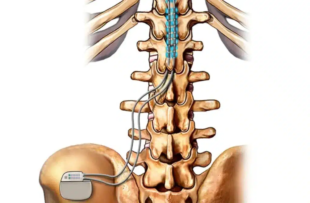 Ilustra&ccedil;&atilde;o de neuromodula&ccedil;&atilde;o espinhal com eletrodos implantados na medula espinhal e gerador de pulsos na regi&atilde;o lombar.