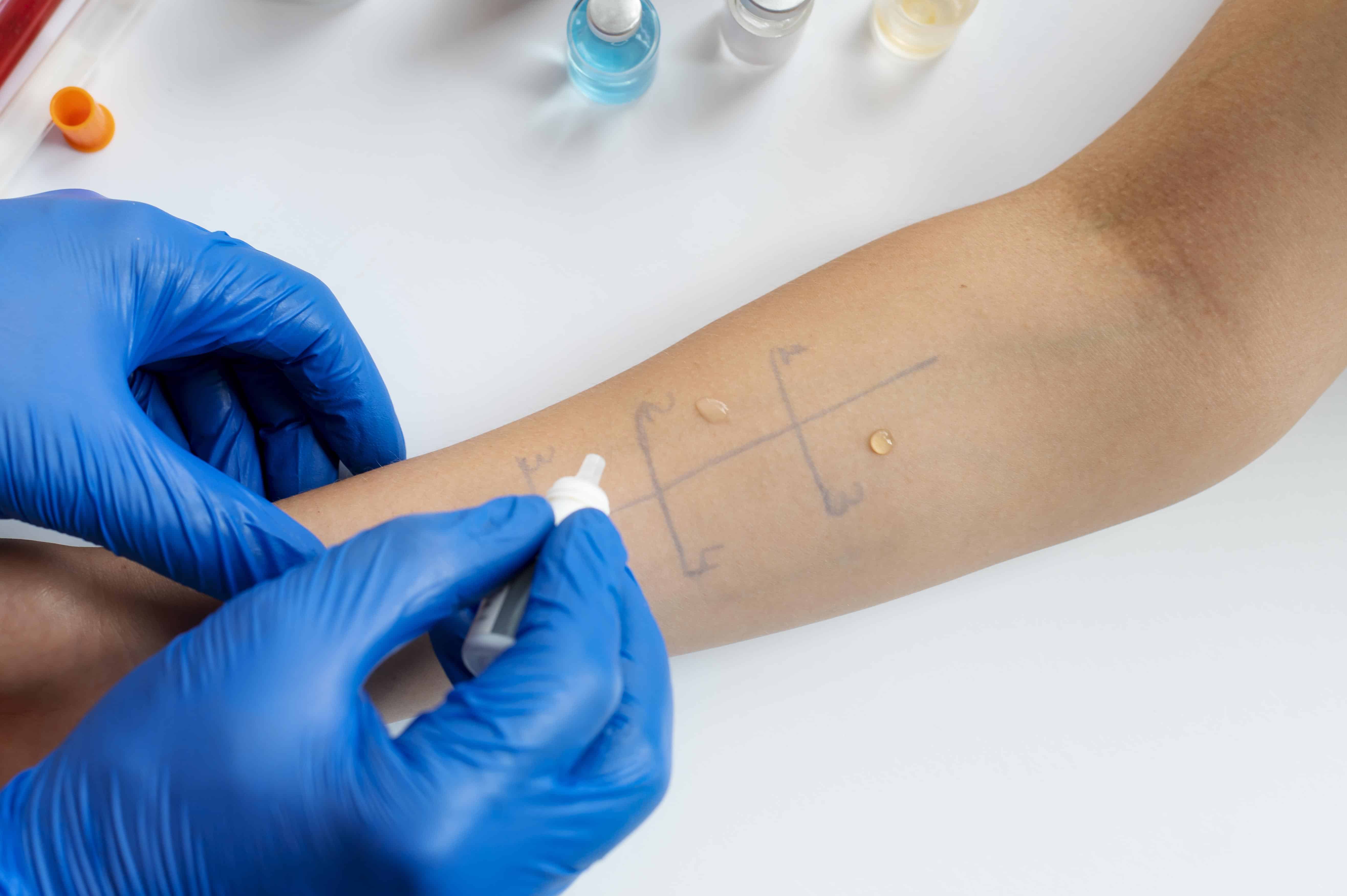 Profissional de sa&uacute;de com luvas azuis realizando um prick test no antebra&ccedil;o de um paciente, aplicando pequenas gotas de al&eacute;rgenos sobre a pele previamente marcada para avalia&ccedil;&atilde;o de alergias.