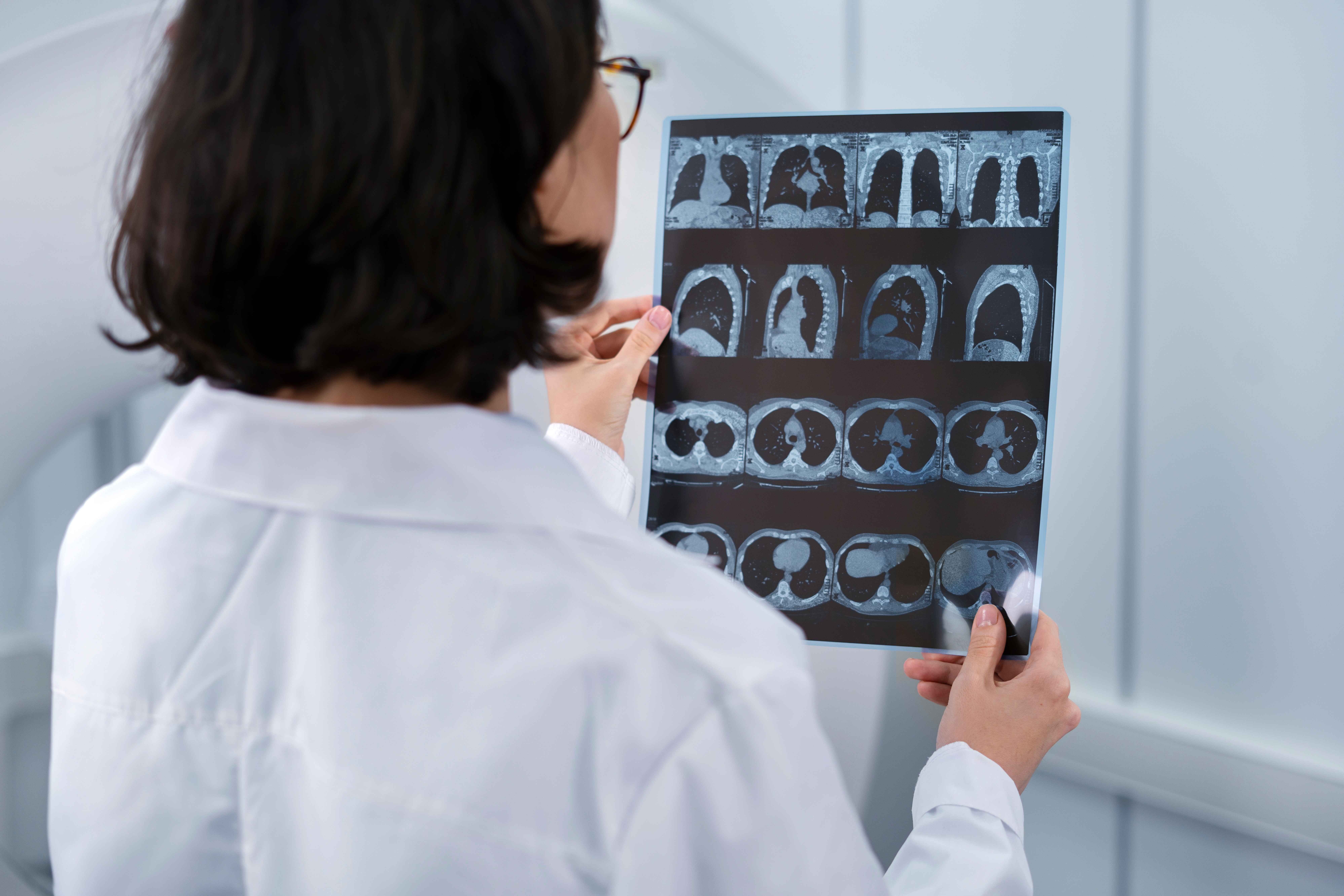 Uma profissional de sa&uacute;de, vestindo jaleco branco, examina uma folha com imagens de tomografia computadorizada dos pulm&otilde;es em um ambiente cl&iacute;nico.