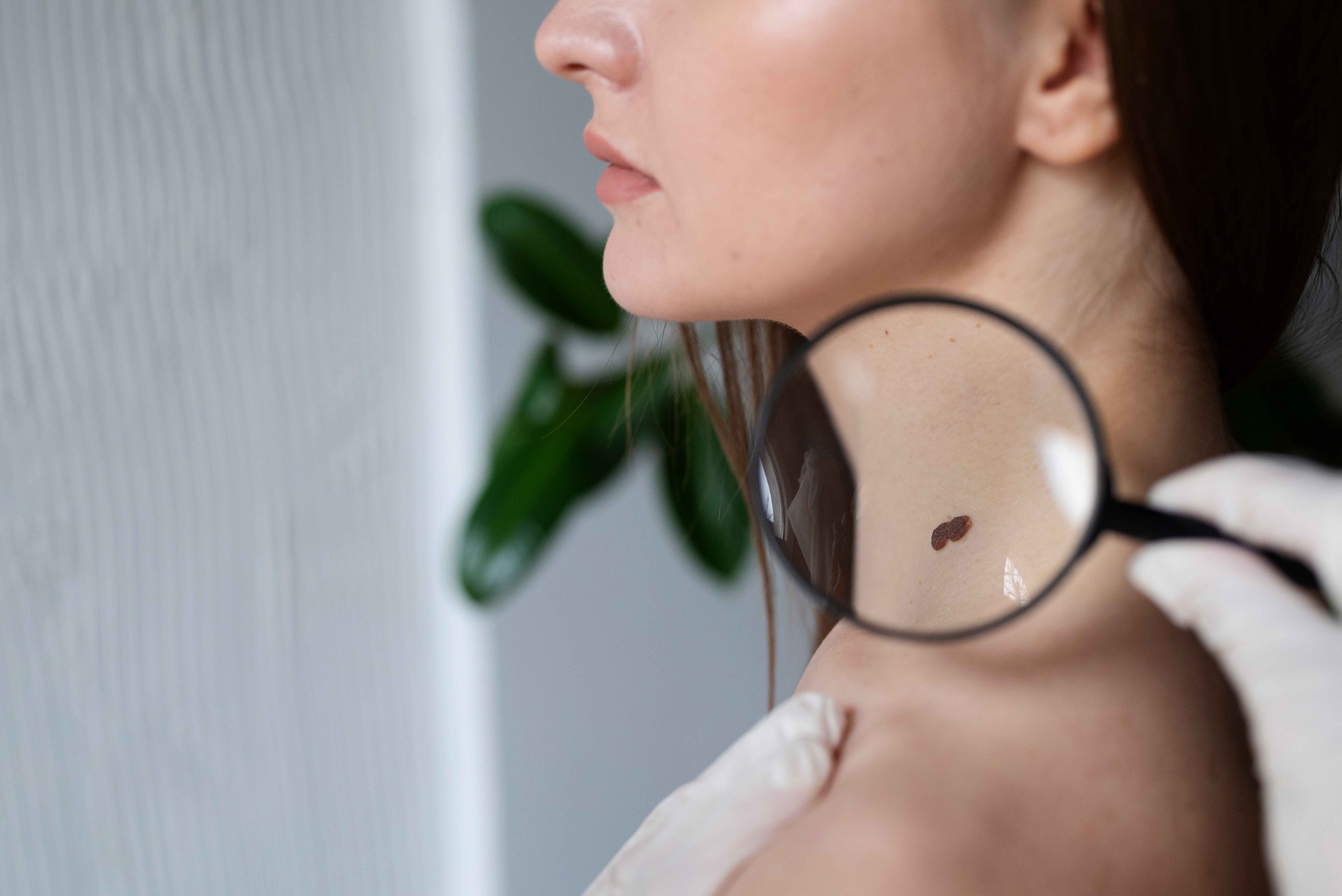 Profissional de sa&uacute;de usando uma lupa para examinar uma pinta escura no pesco&ccedil;o de uma pessoa, durante uma avalia&ccedil;&atilde;o dermatol&oacute;gica para investiga&ccedil;&atilde;o de les&atilde;o de pele ou poss&iacute;vel melanoma.